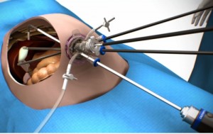 OLYMPUS LESS CHOLECYSTECTOMY